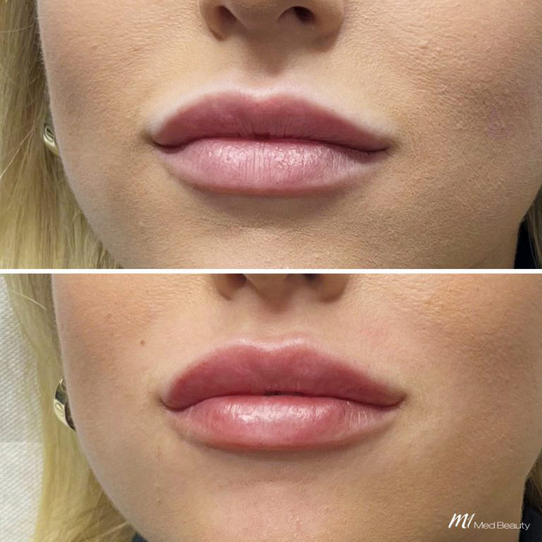Lip Fillers (1)