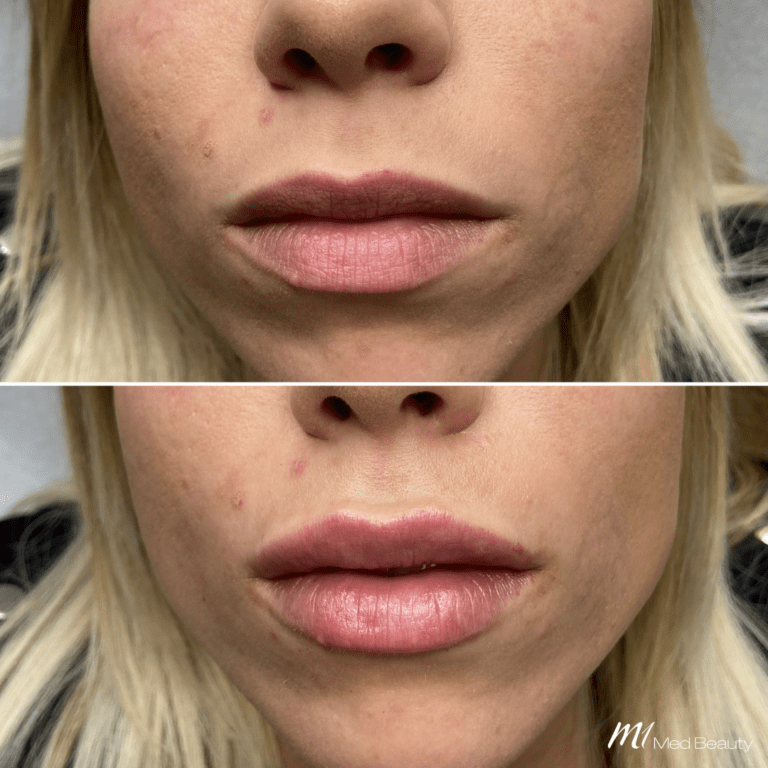 Lip Fillers (2)