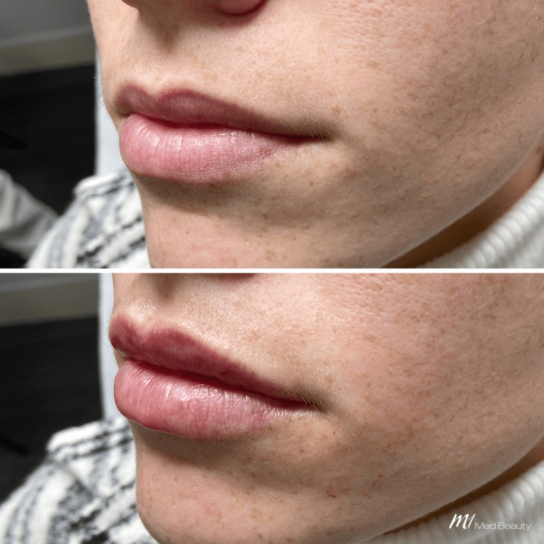 Lip Fillers (3)