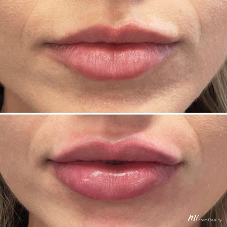 Lip Fillers (4)