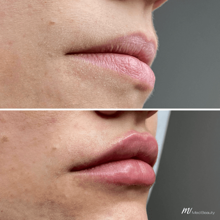 Lip Fillers (5)