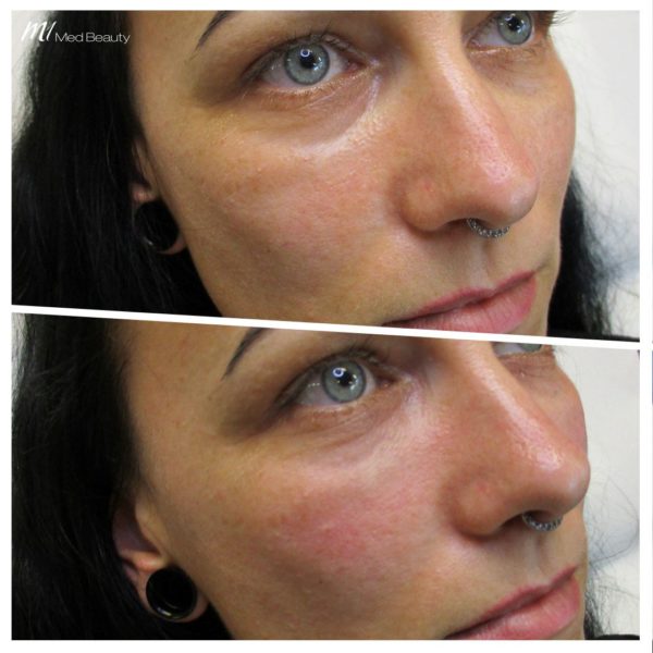tear trough before after (3)